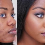 Acne Scar Treatment with Medical Aesthetics: Clearer Skin Solutions